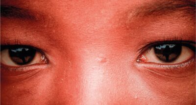 O que é a doença falciforme e como ela afeta a saúde?